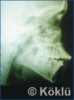 Röntgenbild vor einer Behandlung